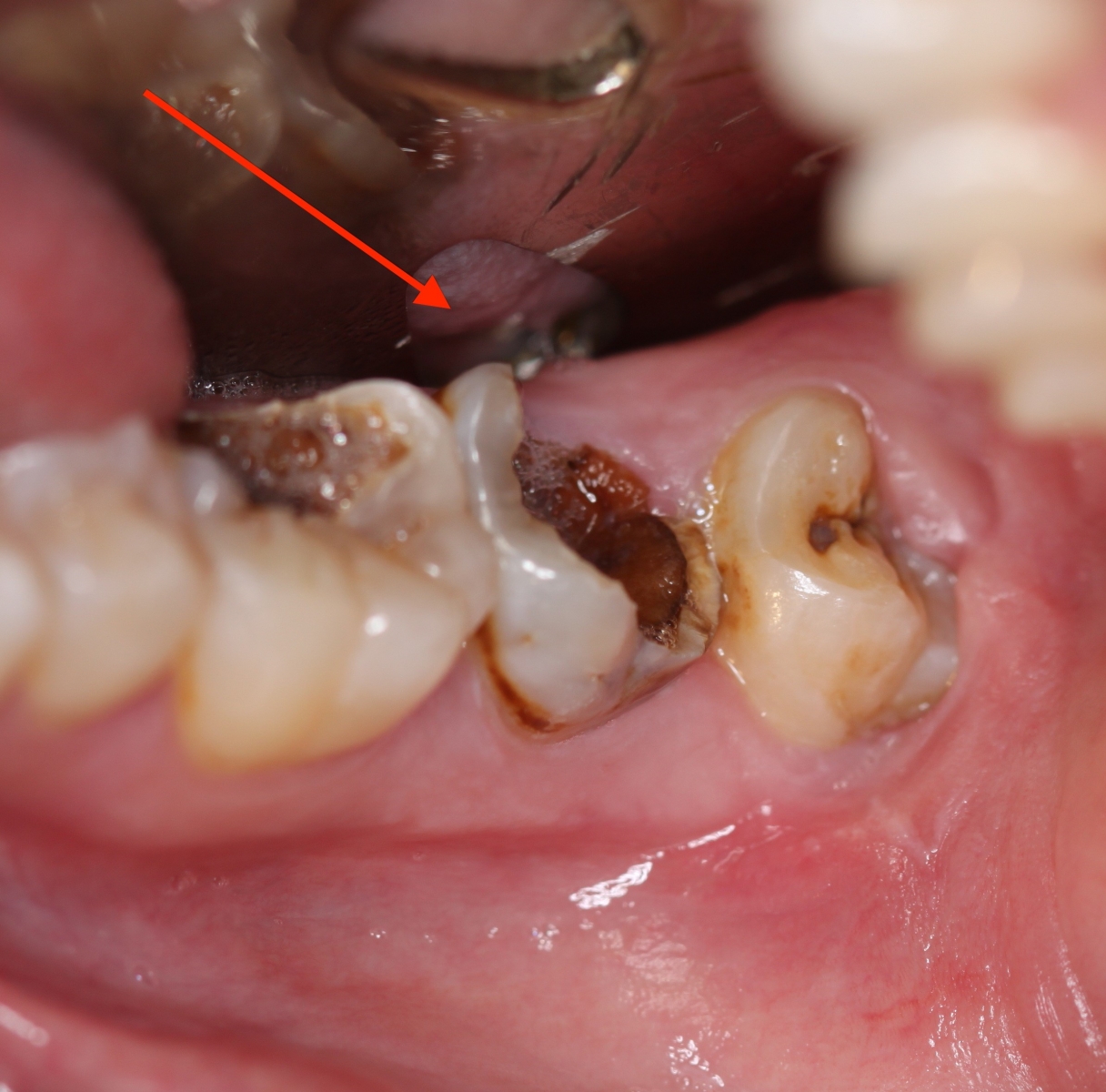 sâu răng và các bệnh lý sâu răng bạn phải biết 
