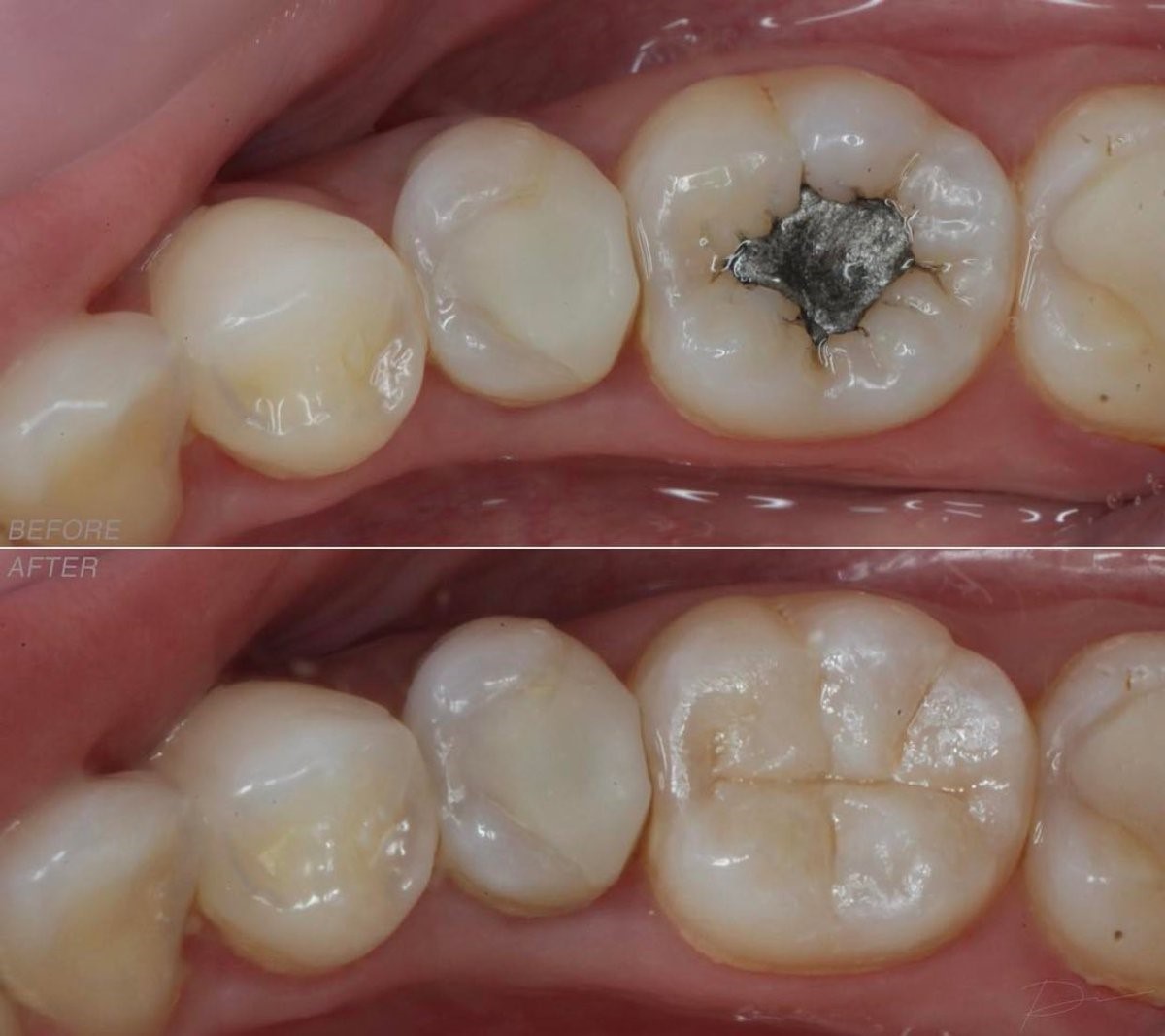 sâu răng và các bệnh lý sâu răng bạn phải biết sâu răng và các bệnh lý sâu răng bạn phải biết
