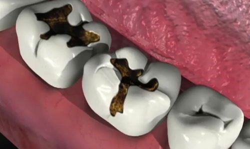 sâu răng và các bệnh lý sâu răng bạn phải biết sâu răng và các bệnh lý sâu răng bạn phải biết