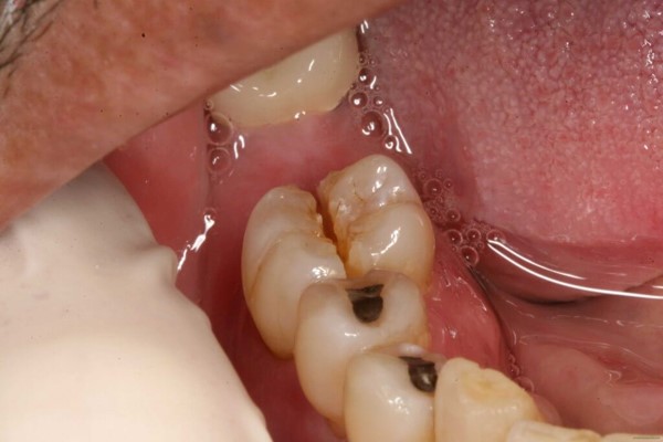 sâu răng và các bệnh lý sâu răng bạn phải biết 