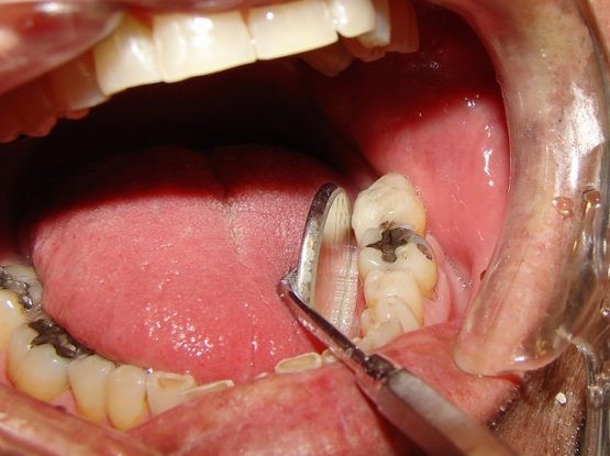 sâu răng và các bệnh lý sâu răng bạn phải biết sâu răng và các bệnh lý sâu răng bạn phải biết