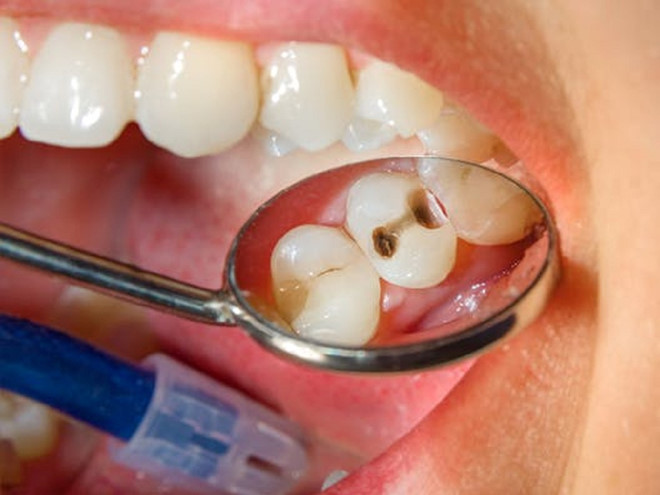 Sâu răng và những vấn đề liên quan mà bạn cần biết Sâu răng và những vấn đề liên quan mà bạn cần biết