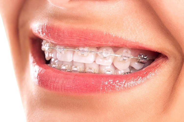 Tác dụng của niềng răng mà bạn nên biết Tác dụng của niềng răng mà bạn nên biết