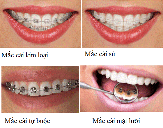 Tác dụng của niềng răng mà bạn nên biết