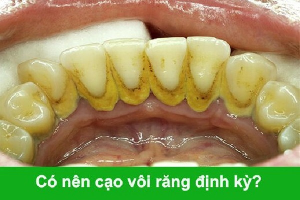 Tác hại của vôi răng Cạo vôi răng có đau hay không