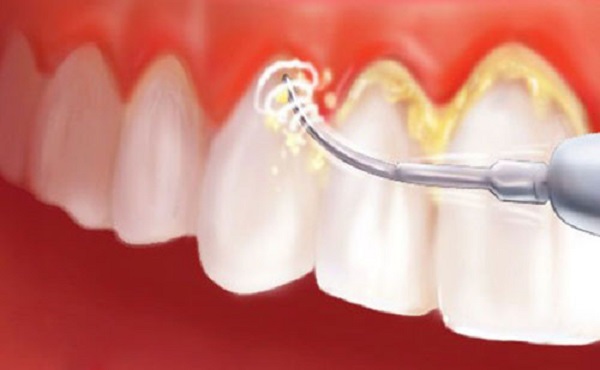 Tác hại của vôi răng Cạo vôi răng có đau hay không