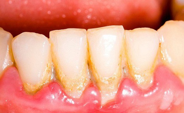 Tác hại của vôi răng Cạo vôi răng có đau hay không