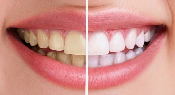 tẩy trắng răng bị nhiễm tetracyclene