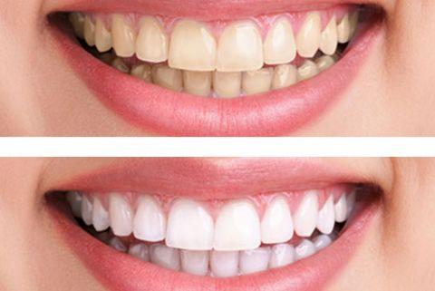 tẩy trang răng tẩy trang răng