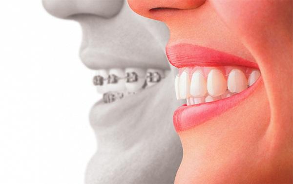 Niềng răng mất bao lâu? Niềng răng mất bao lâu?