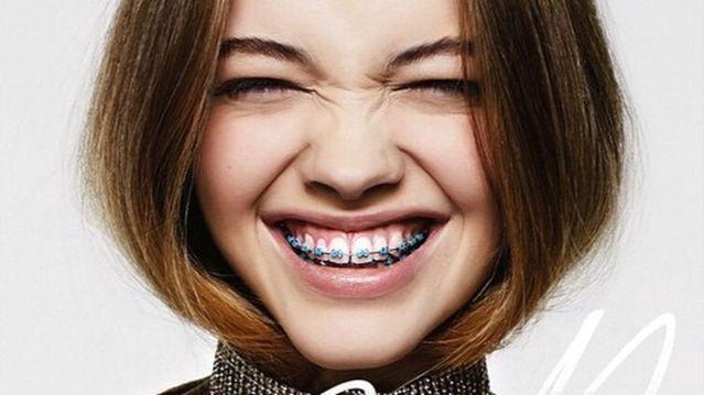 thời gian niềng răng thời gian niềng răng