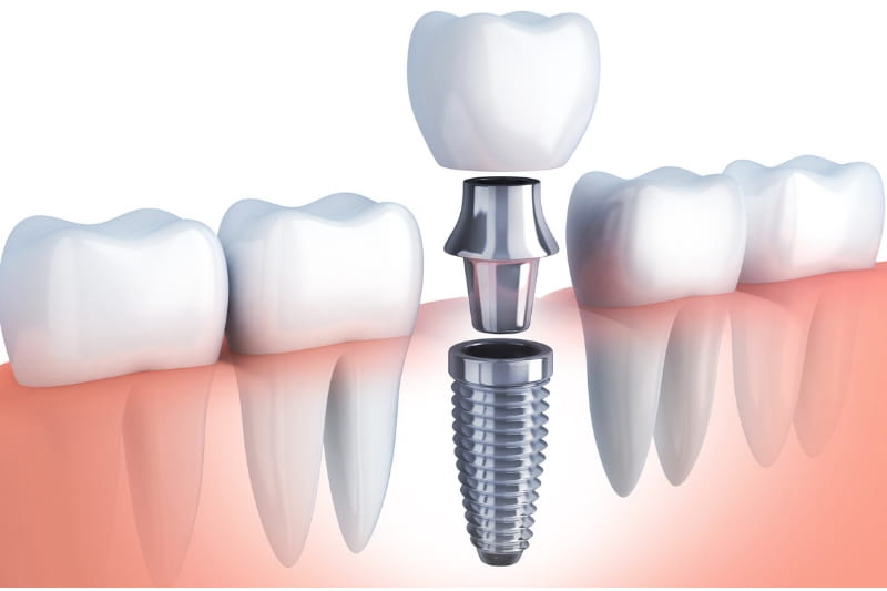 Tìm hiểu về quy trình cấy ghép răng implant Tìm hiểu về quy trình cấy ghép răng implant