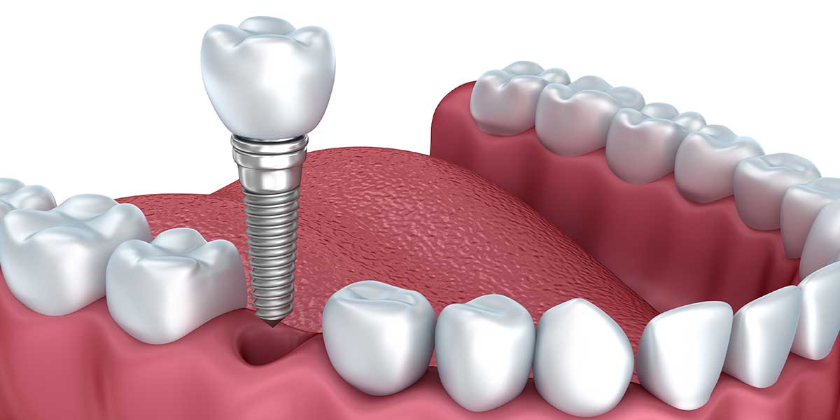 Tìm hiểu về quy trình cấy ghép răng implant Tìm hiểu về quy trình cấy ghép răng implant