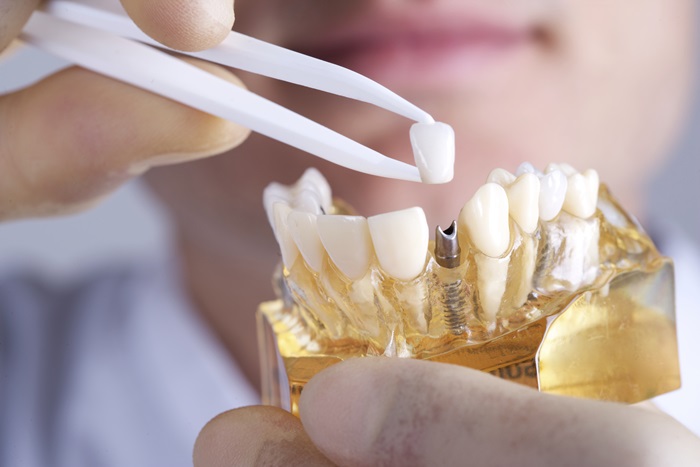 Tìm hiểu về quy trình cấy ghép răng implant Tìm hiểu về quy trình cấy ghép răng implant