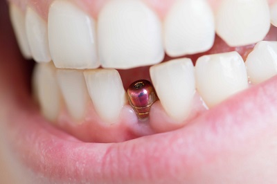 Tìm hiểu về quy trình cấy ghép răng implant