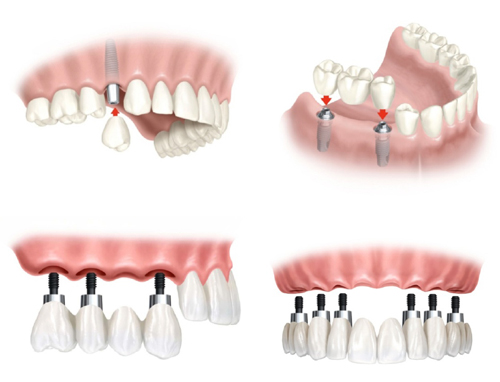 Tìm hiểu về quy trình cấy ghép răng implant Tìm hiểu về quy trình cấy ghép răng implant