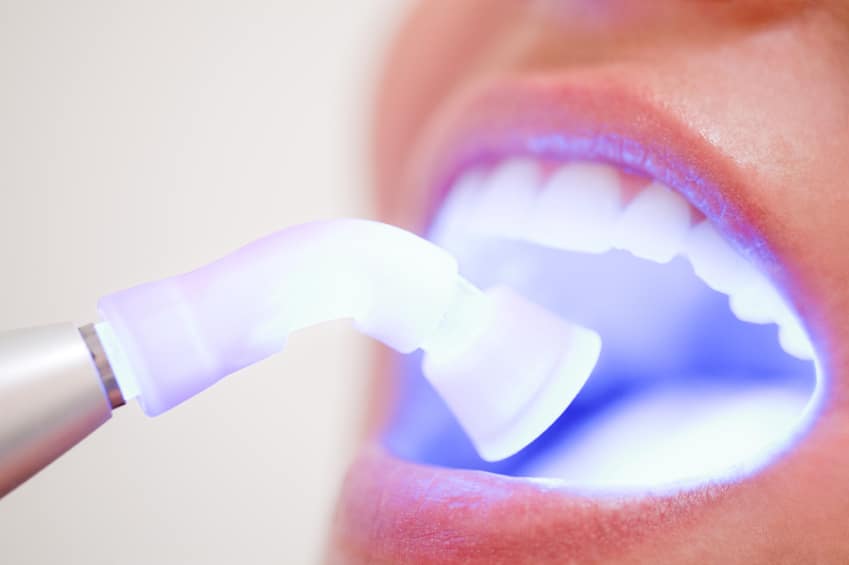 Top công nghệ tẩy trắng răng hiệu quả nhất hiện nay