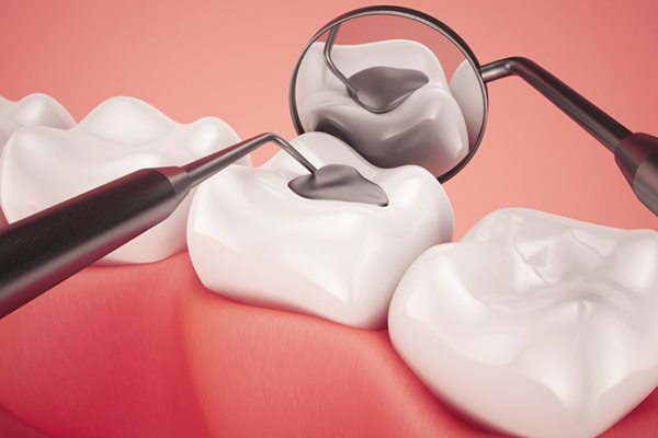 Trám răng có ảnh hưởng gì không