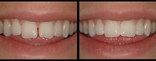 trám răng thẩm mỹ tại nha khoa tân phú trám răng thẩm mỹ tại nha khoa tân phú