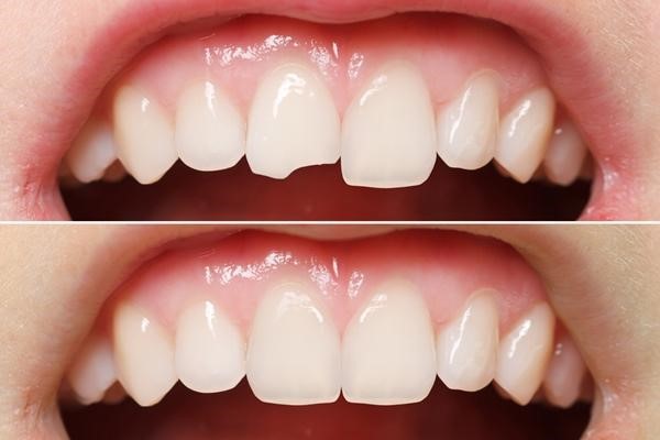 trám răng thẩm mỹ tại nha khoa tân phú trám răng thẩm mỹ tại nha khoa tân phú
