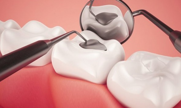 trám răng thẩm mỹ tại nha khoa tân phú trám răng thẩm mỹ tại nha khoa tân phú