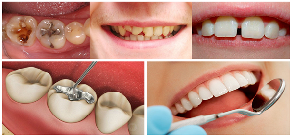trám răng thẩm mỹ tại nha khoa tân phú trám răng thẩm mỹ tại nha khoa tân phú