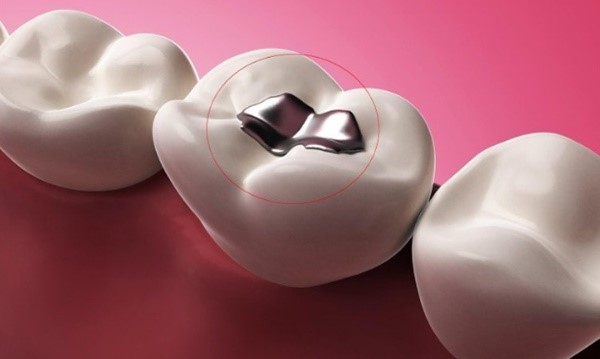 trám răng thẩm mỹ tại nha khoa tân phú trám răng thẩm mỹ tại nha khoa tân phú