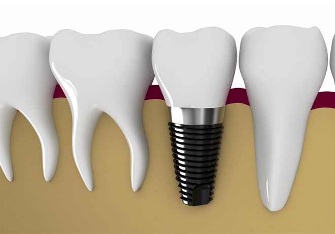 Trồng implant tại tân phú