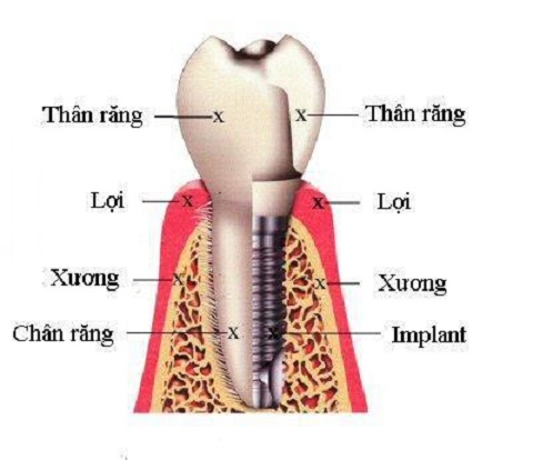 Trồng răng Implant có nguy hiểm không Trồng răng Implant có nguy hiểm không