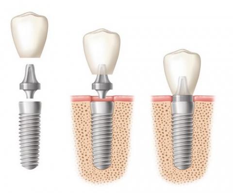 Trồng răng Implant có nguy hiểm không Trồng răng Implant có nguy hiểm không