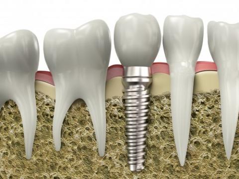 Trồng răng Implant có nguy hiểm không Trồng răng Implant có nguy hiểm không