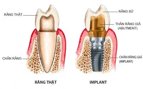 Trồng răng Implant có nguy hiểm không Trồng răng Implant có nguy hiểm không