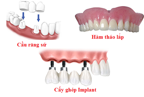 Trồng răng implant tại quận 10