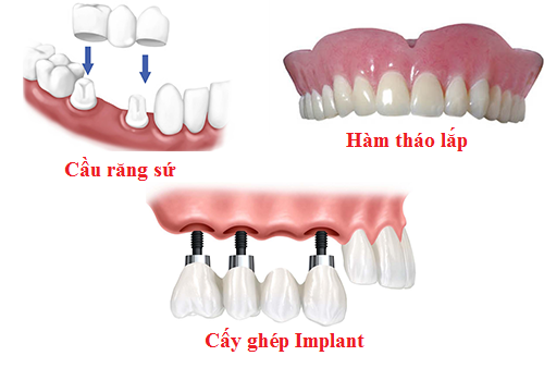 Trồng răng implant tại quận 10 Trồng răng implant tại quận 10