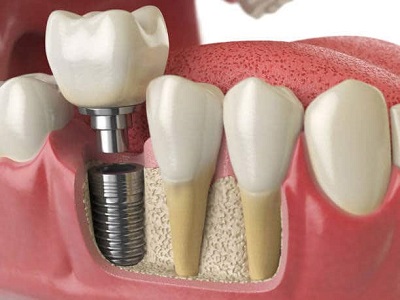 Trồng răng implant tại quận 10