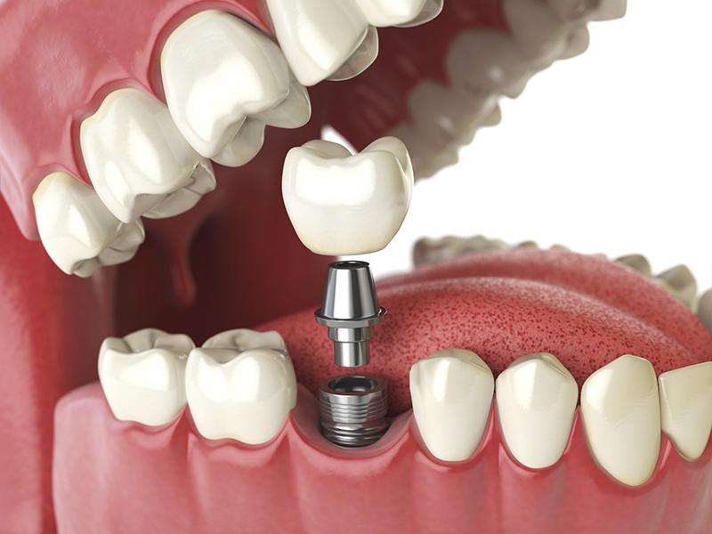Trồng răng Implant và những điều cần biết Trồng răng Implant và những điều cần biết