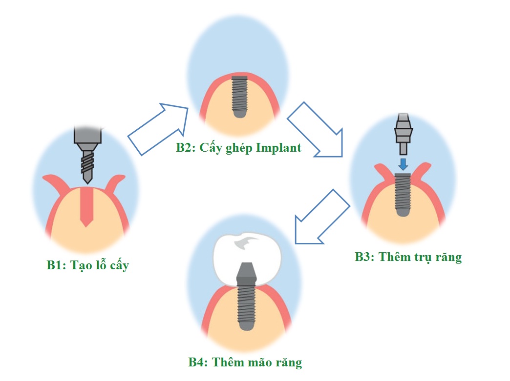 Trồng răng Implant và những điều cần biết Trồng răng Implant và những điều cần biết