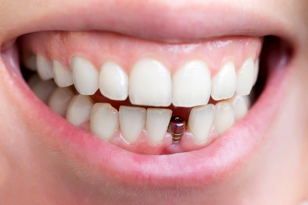 Trồng răng Implant và những điều cần biết Trồng răng Implant và những điều cần biết