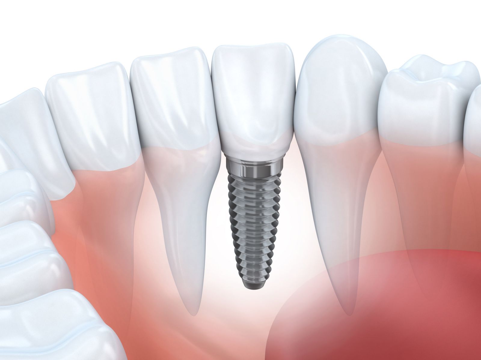 Trường hợp nào nên trồng Implant cho răng