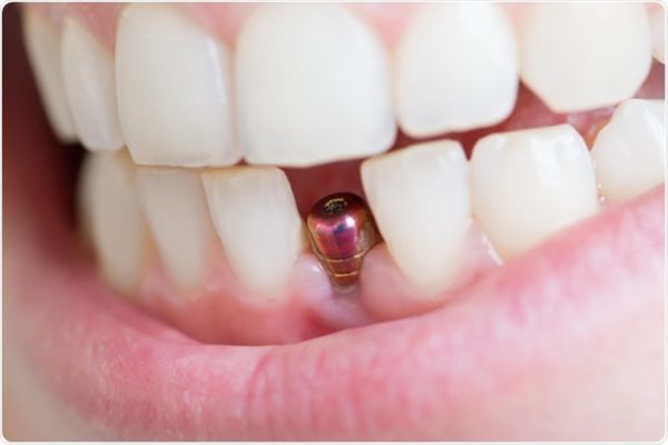 Trường hợp nào nên trồng Implant cho răng Trường hợp nào nên trồng Implant cho răng