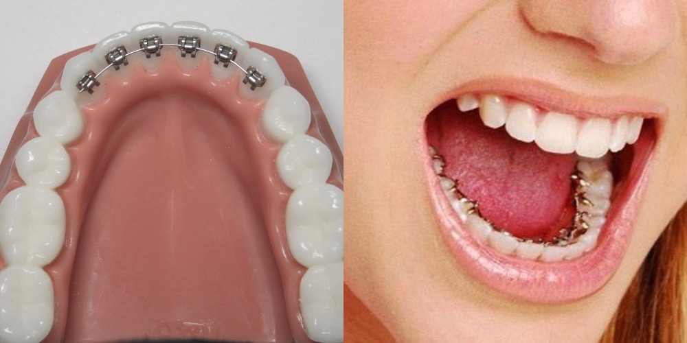 Trưởng thành niềng răng có là quá trễ hay không Trưởng thành niềng răng có là quá trễ hay không