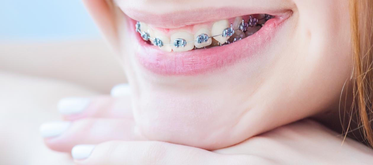 Trưởng thành niềng răng có là quá trễ hay không Trưởng thành niềng răng có là quá trễ hay không
