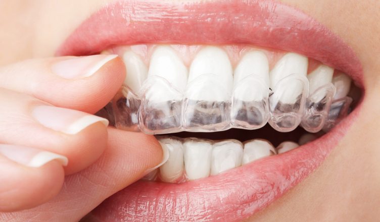 Trưởng thành niềng răng có là quá trễ hay không Trưởng thành niềng răng có là quá trễ hay không