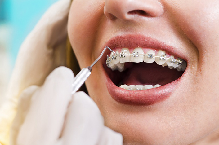 Tư vấn về các loại niềng răng hiện nay và ưu nhược điểm của chúng Tư vấn về các loại niềng răng hiện nay và ưu nhược điểm của chúng