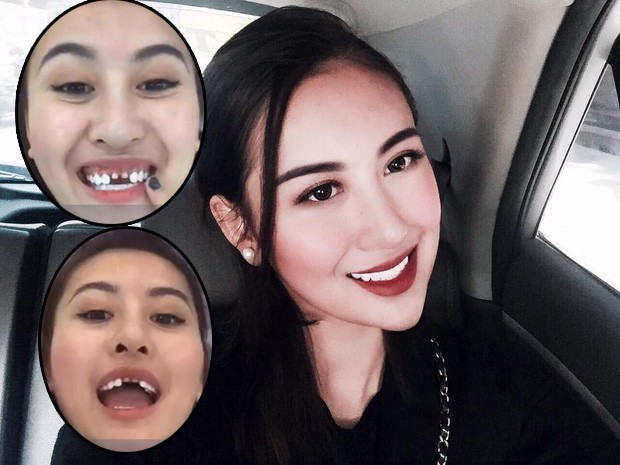 tưng bừng khuyến mãi cùng nha khoa 3t