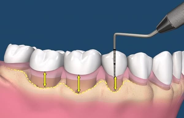 Tụt lợi chân răng và những điều cần biết