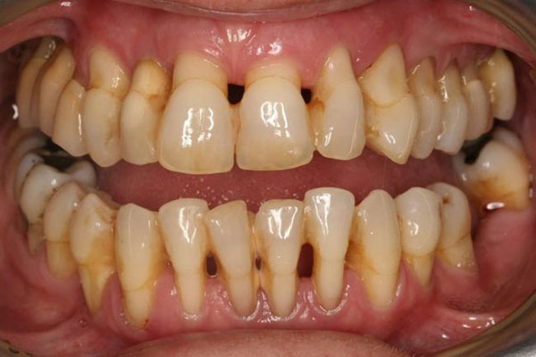 Viêm nha chu và tác hại khó lường Viêm nha chu và tác hại khó lường