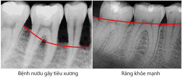 Viêm nha chu và tác hại khó lường