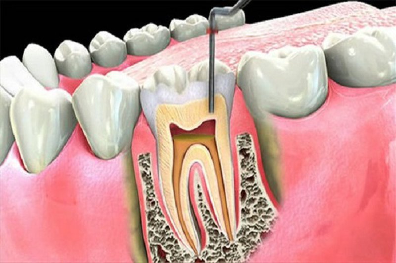 Viêm tủy răng và những biến chứng nguyên hiểm của nó Viêm tủy răng và những biến chứng nguyên hiểm của nó