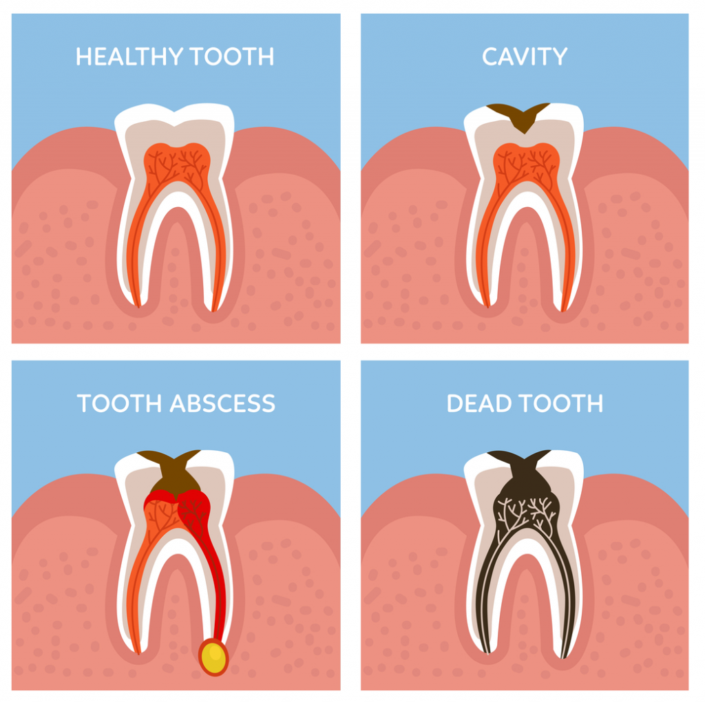 Viêm tủy răng và những biến chứng nguyên hiểm của nó Viêm tủy răng và những biến chứng nguyên hiểm của nó